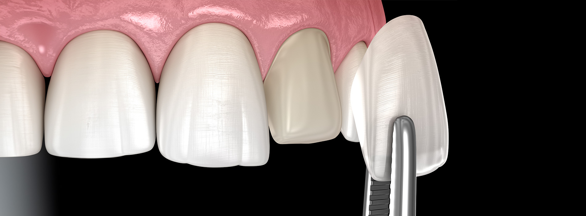The image shows a close-up of a dental implant fixture with a screwdriver inserted into it against a dark background, suggesting a dental care setting.